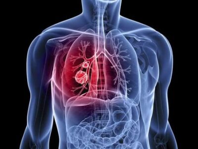 El aumento de peso no es favorable para los pulmones que envejecen