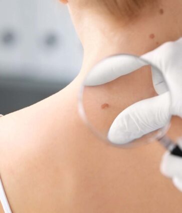 Dermatólogos alertan del cuidado de la piel para prevenir el melanoma