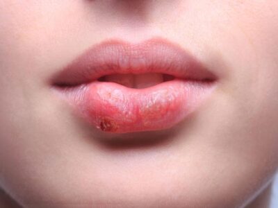 Qué hacer si me aparece herpes labial y cómo prevenirlo
