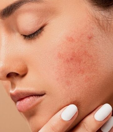 5 hábitos que empeoran tu acné y estimulan su aparición
