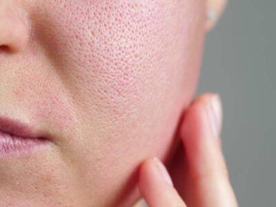 Tienes la piel con muchos poros abiertos. ¿Esto te recomendamos?