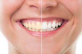 ¿Blanquear los dientes con bicarbonato es bueno o malo? 