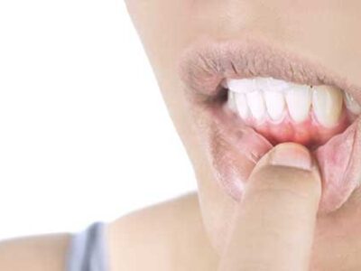5 condiciones de salud relacionadas con enfermedad de las encías