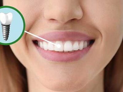 Implantes dentales cosméticos, información clave que debes conocer
