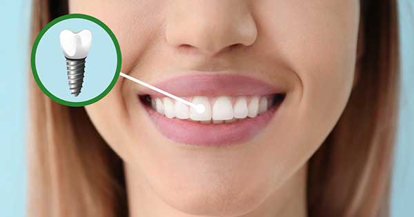Implantes dentales cosméticos, información clave que debes conocer